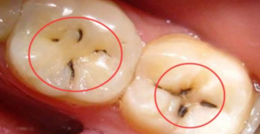 牙齿上的小黑点 蛀牙 其实 是牙齿对你发送 求救 信号 知乎
