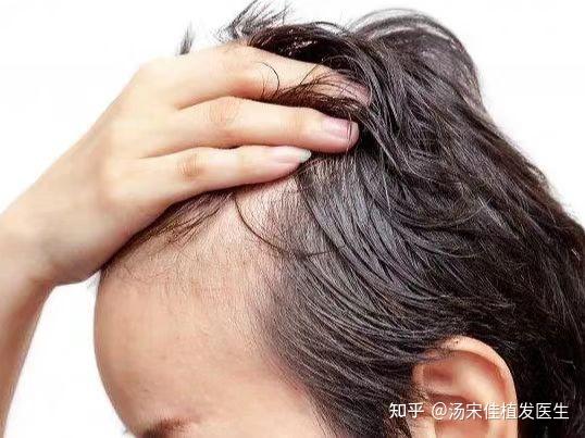 发际线高怎么办?怎样降低发际线? - 知乎