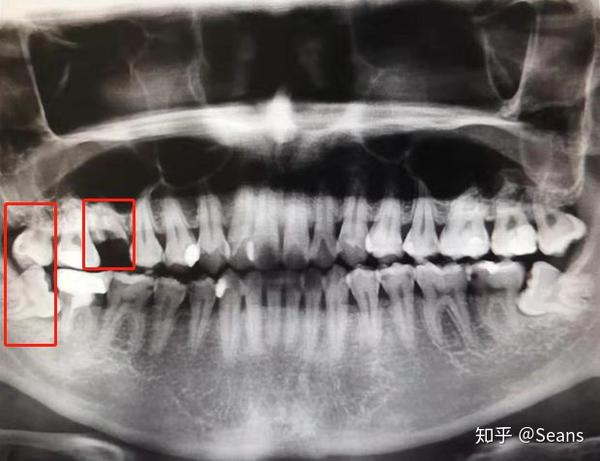 拔牙引起上颌窦穿孔是什么体验? - 知乎
