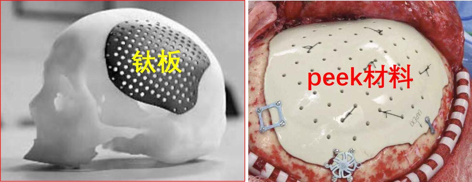 颅骨修补有没有必要什么时机修补最好什么材料最合适手术有没有风险