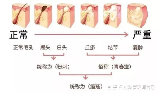 祛痘原理图片