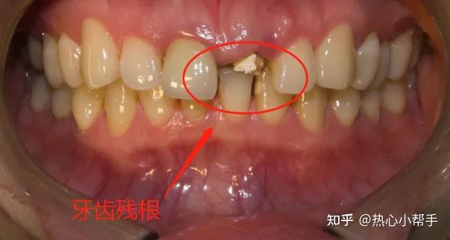 留着残根、残冠不拔会有哪些危害? - 知乎