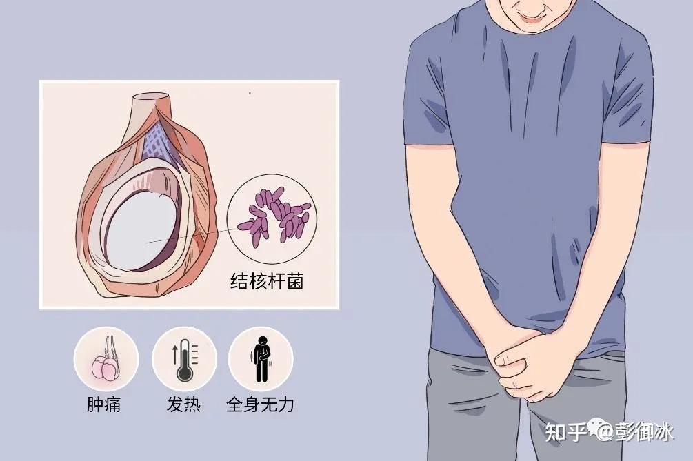 附睾结核的主要后遗症是附睾管和近端输精管不全或完全梗阻,可表现为