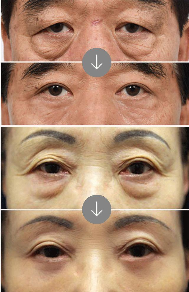 关于眼袋?