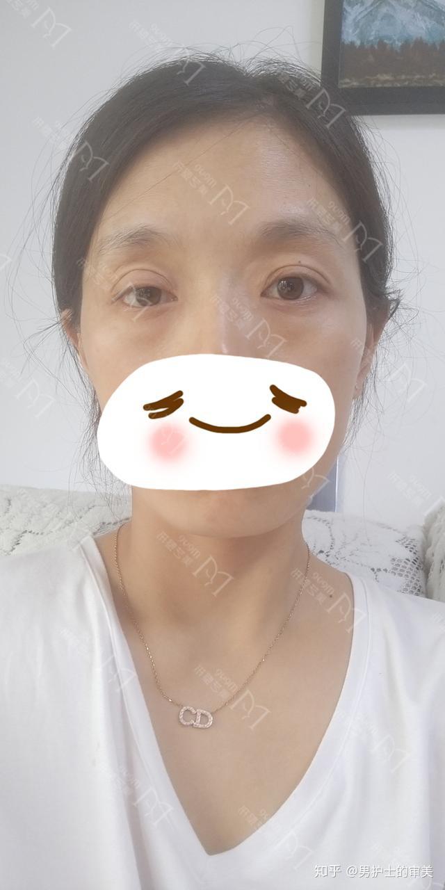 登封30岁姑娘做了双眼皮眼窝凹大小眼是咋回事