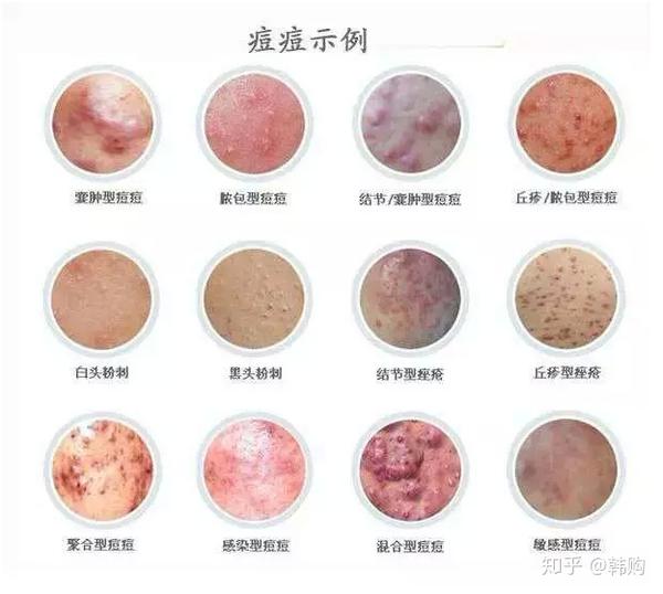 不同部位的痘痘代表图图片