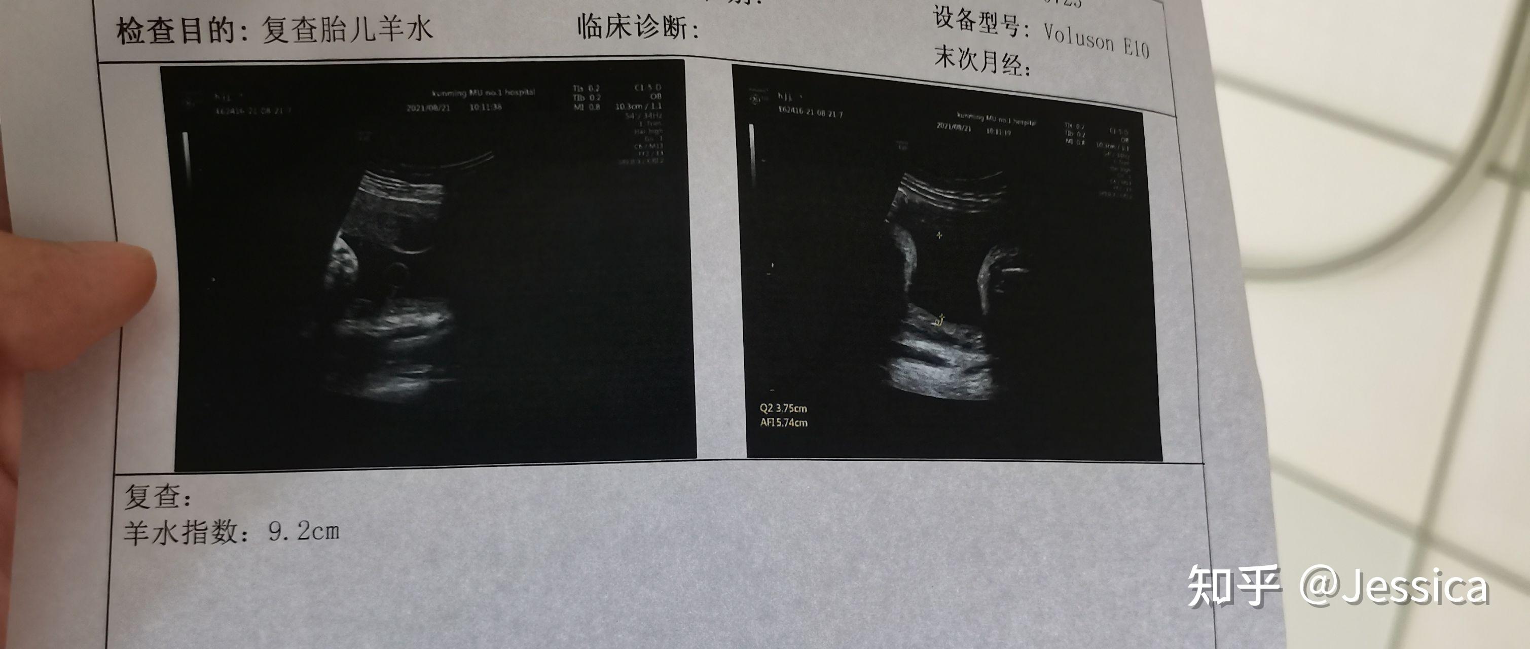 孕妈36周破水早产，质疑胎儿“挠破”的，医生|胎膜早破|早产|医生_新浪新闻