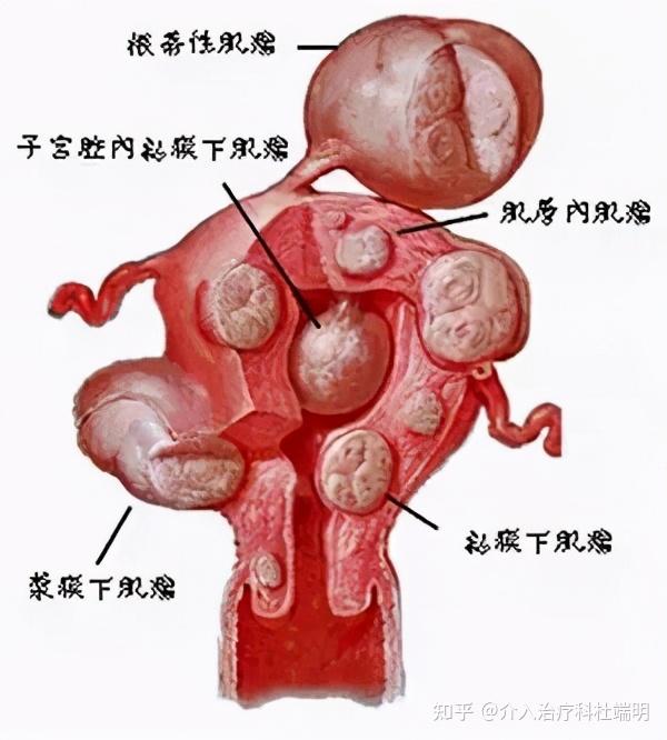 子宫肌瘤长在哪里图片