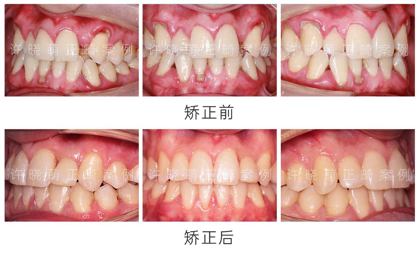 67正畸前后口内照对比