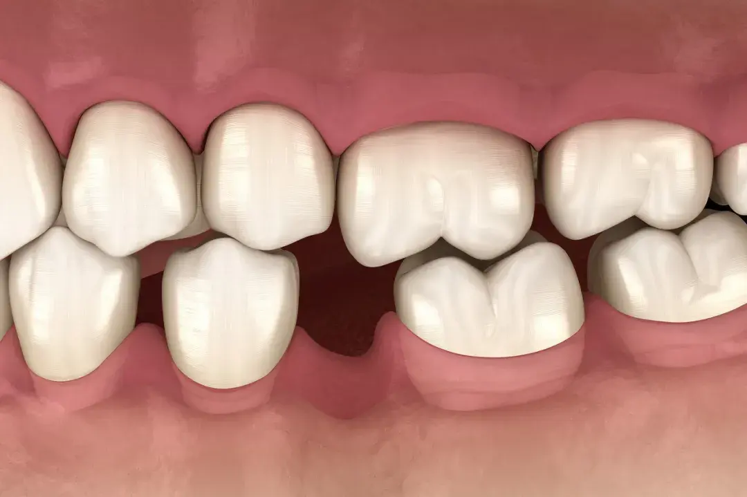 我们先来看看,缺牙后邻牙是怎么歪的:视频号牙齿咬合不齐怎么办?