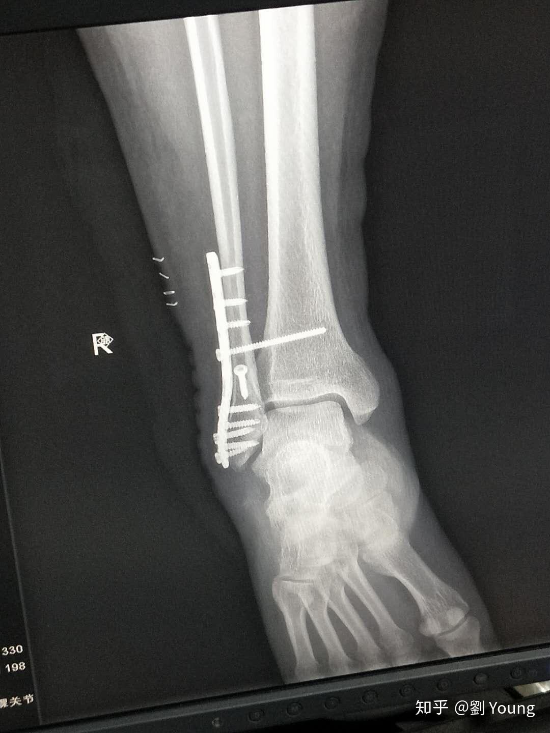 右外踝骨折踝关节前脱位腓骨末端骨裂右侧腓神经损伤的手术康复日记