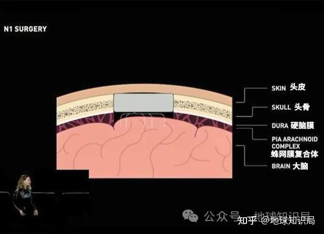 大脑芯片植入技术图片
