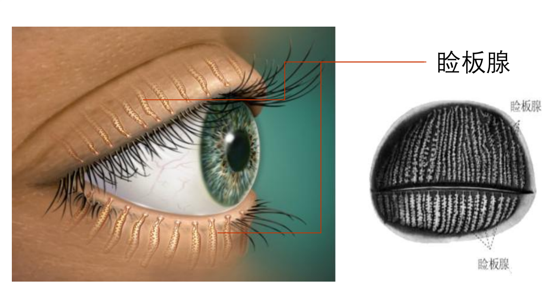 與瞼板腺功能障礙相關的乾眼竟高達90%*以上,可以說,使瞼板腺功能正常