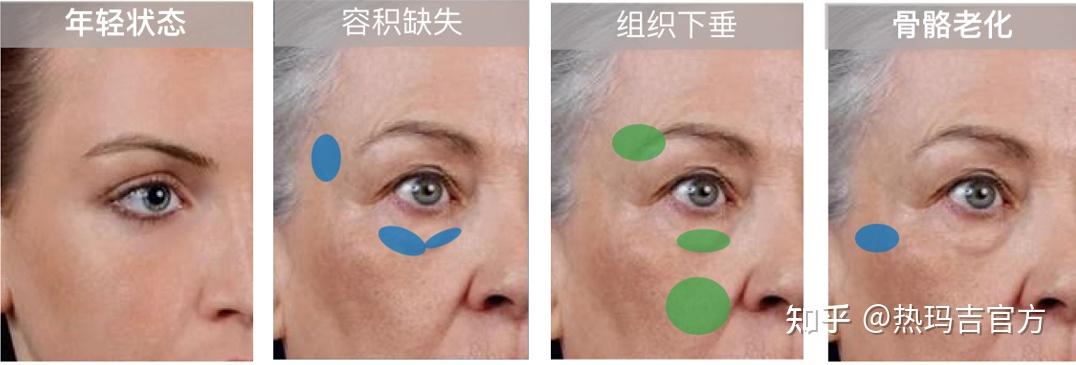 眼部皮肤松弛怎么处理?眼部皱纹怎么去除最有效果? - 知乎