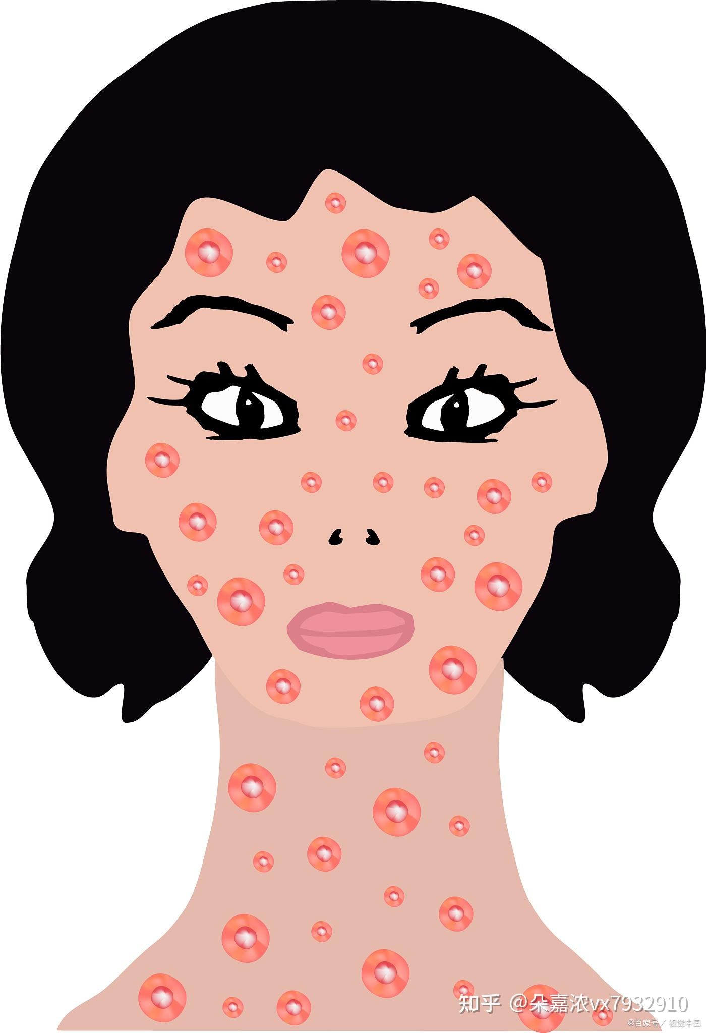 什么是激素脸的戒断期激素脸戒断期是什么