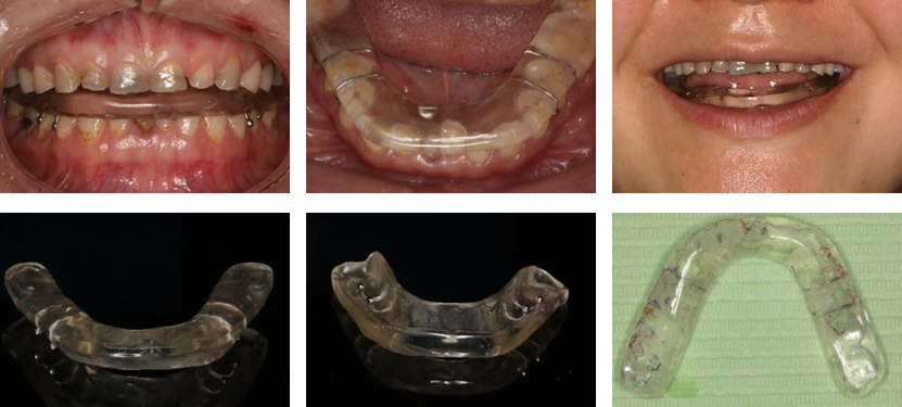 上下颌牙列重度磨耗的美学与咬合重建第七届口腔跨学科优秀病例展