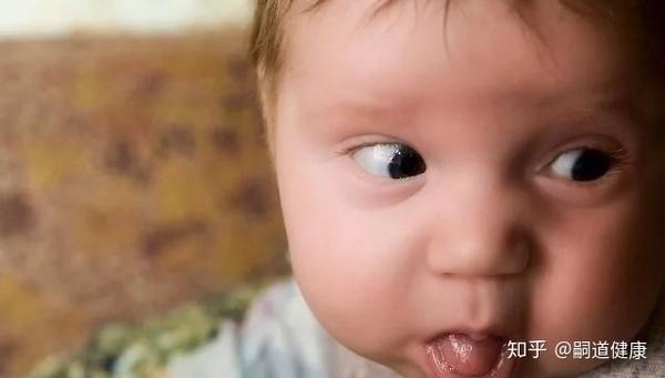 威廉姆斯综合征是一种罕见的遗传疾病,影响孩子的成长,身体外观和认知