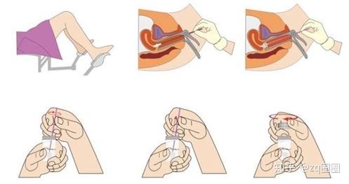 hpv检查方法有哪些?