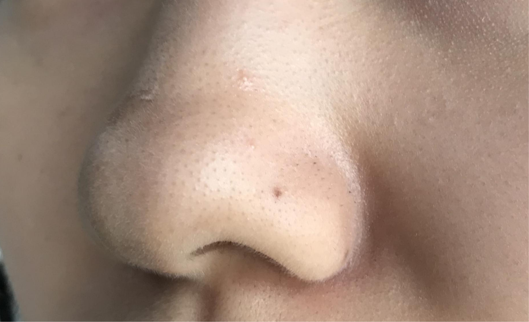 因为说白了,黑头其实就是氧化的油脂