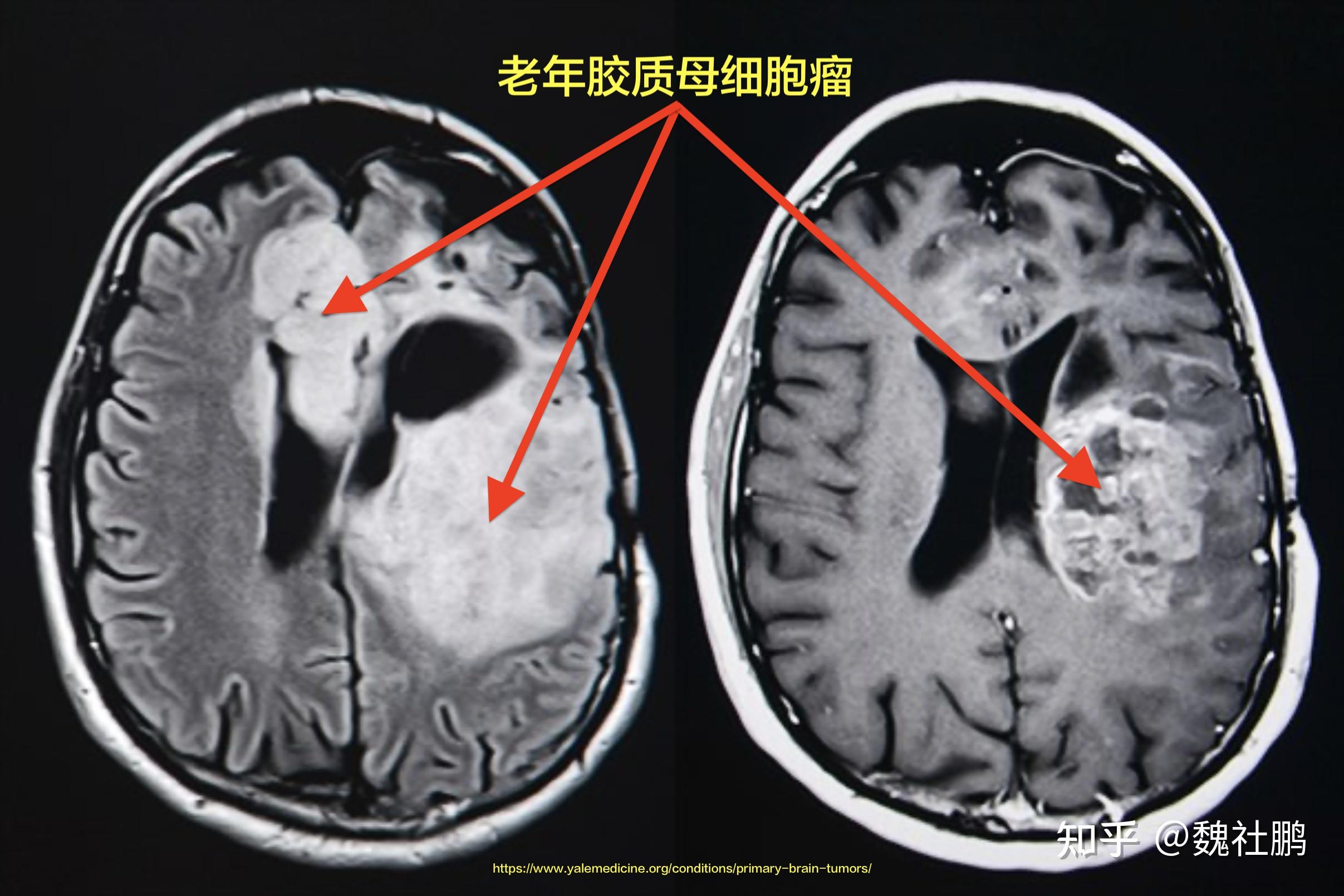 星形细胞脑瘤 