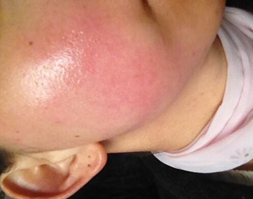 并且有的还会让激素脸的问题越发的严重了,这种情况极易