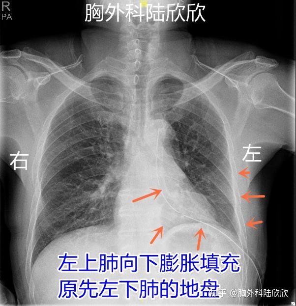 左肺体表投影图片