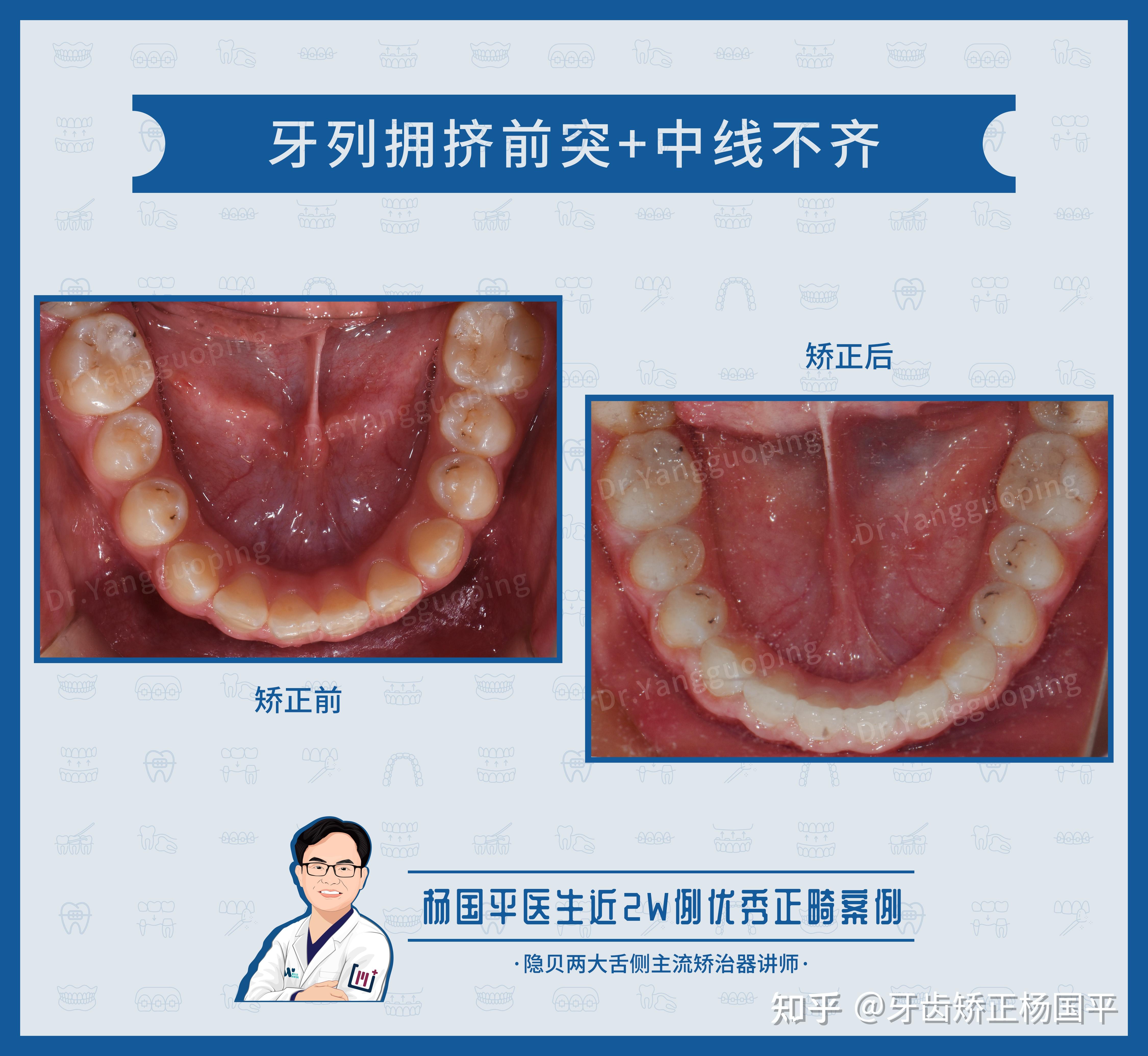 牙齿上下排的正确位置图片