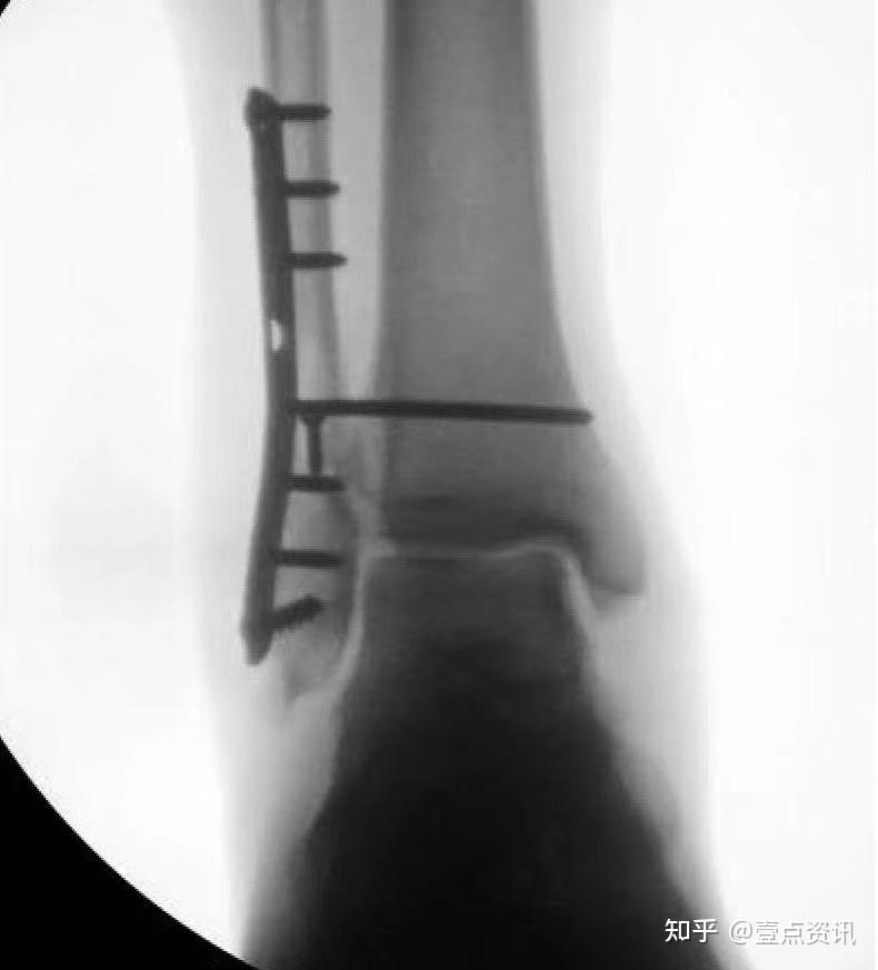 五四一总医院骨科关节病区顺利开展"锁扣带袢钛板固定下胫腓分离手术"