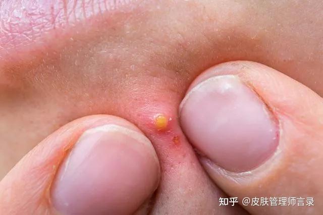 月经前长痘痘正常吗