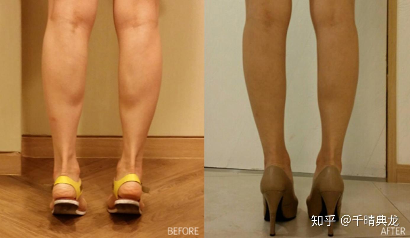 肌肉腿和正常腿的对比图片