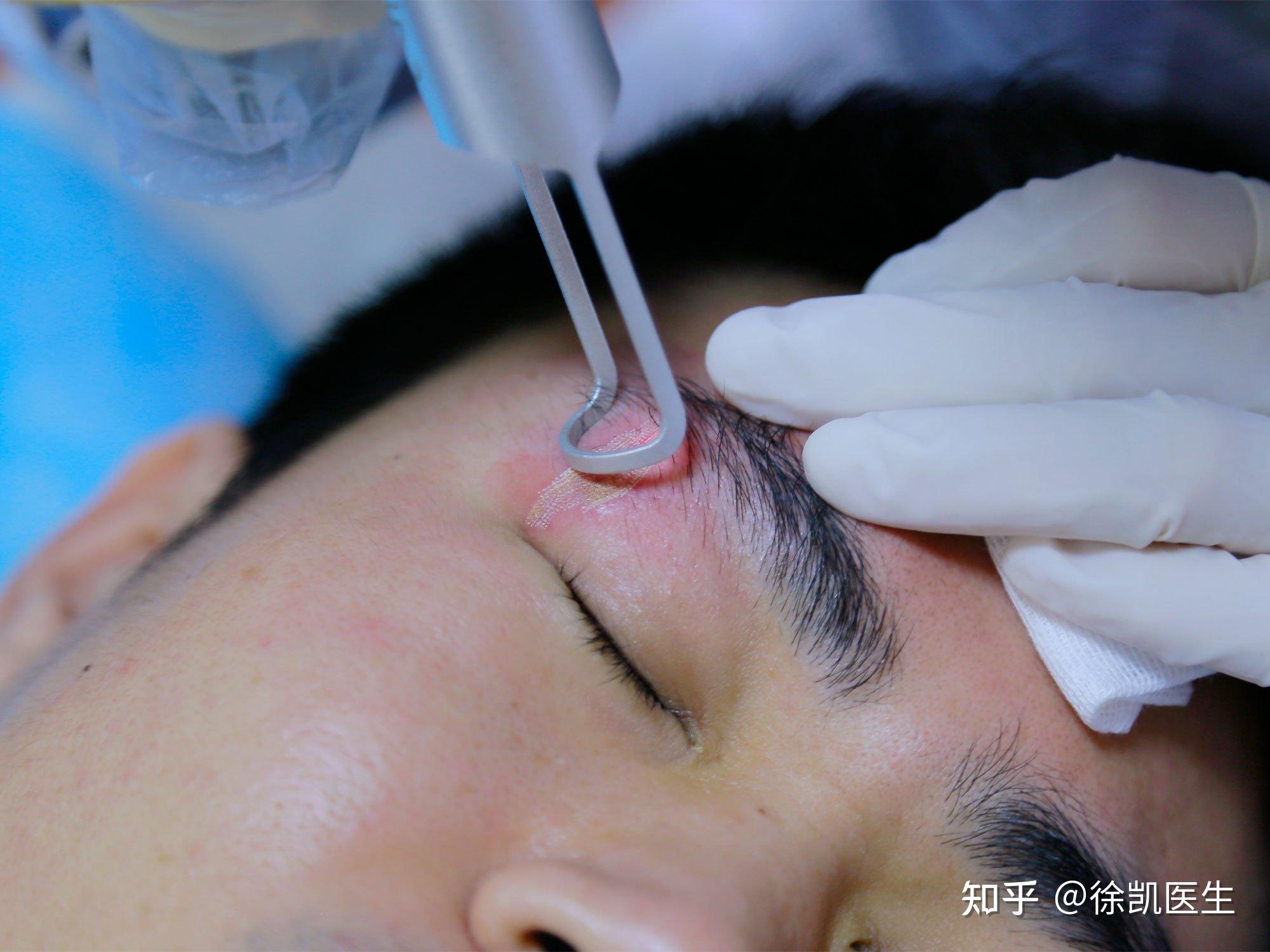 疤痕增生做激光疼吗