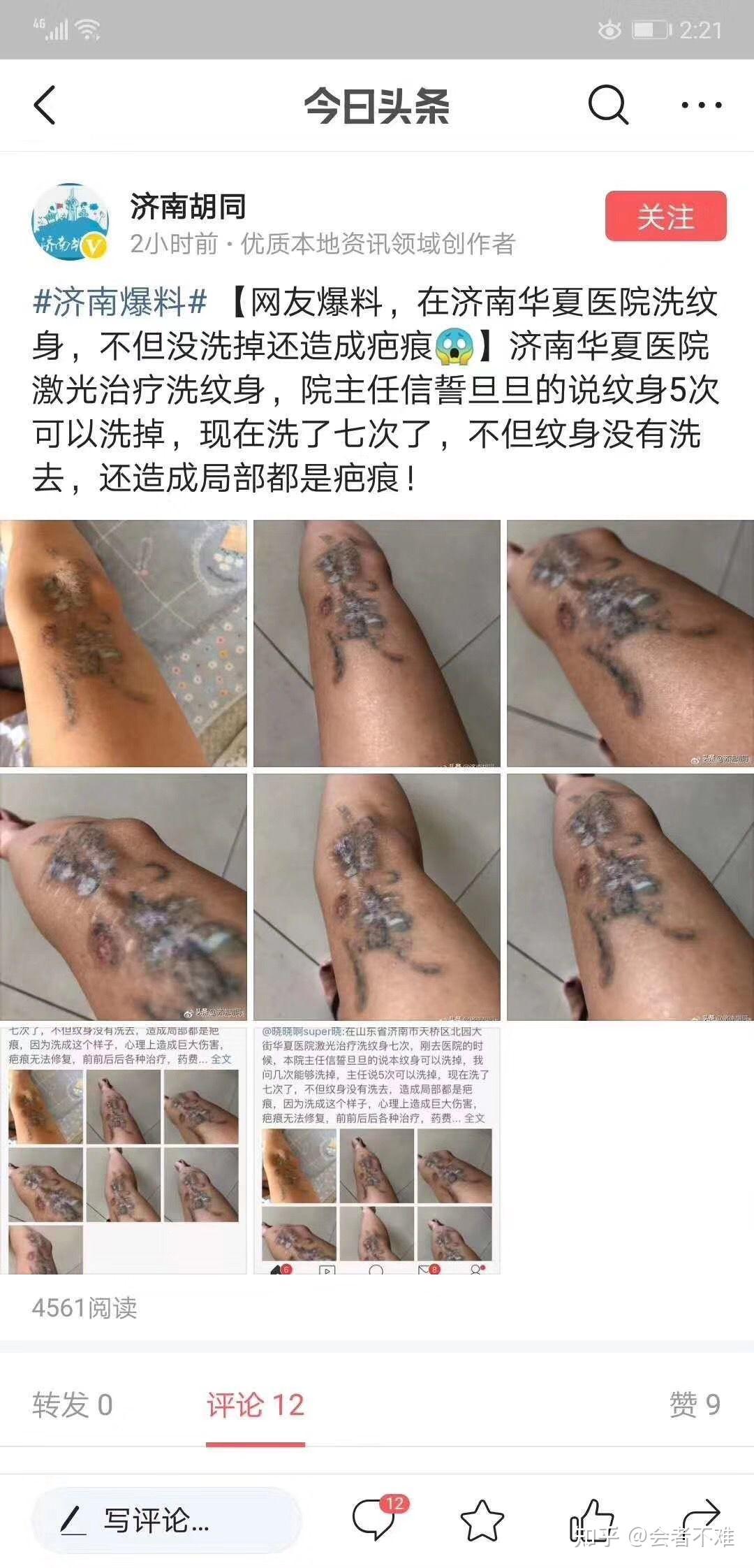 聊城洗纹身的正规医院图片