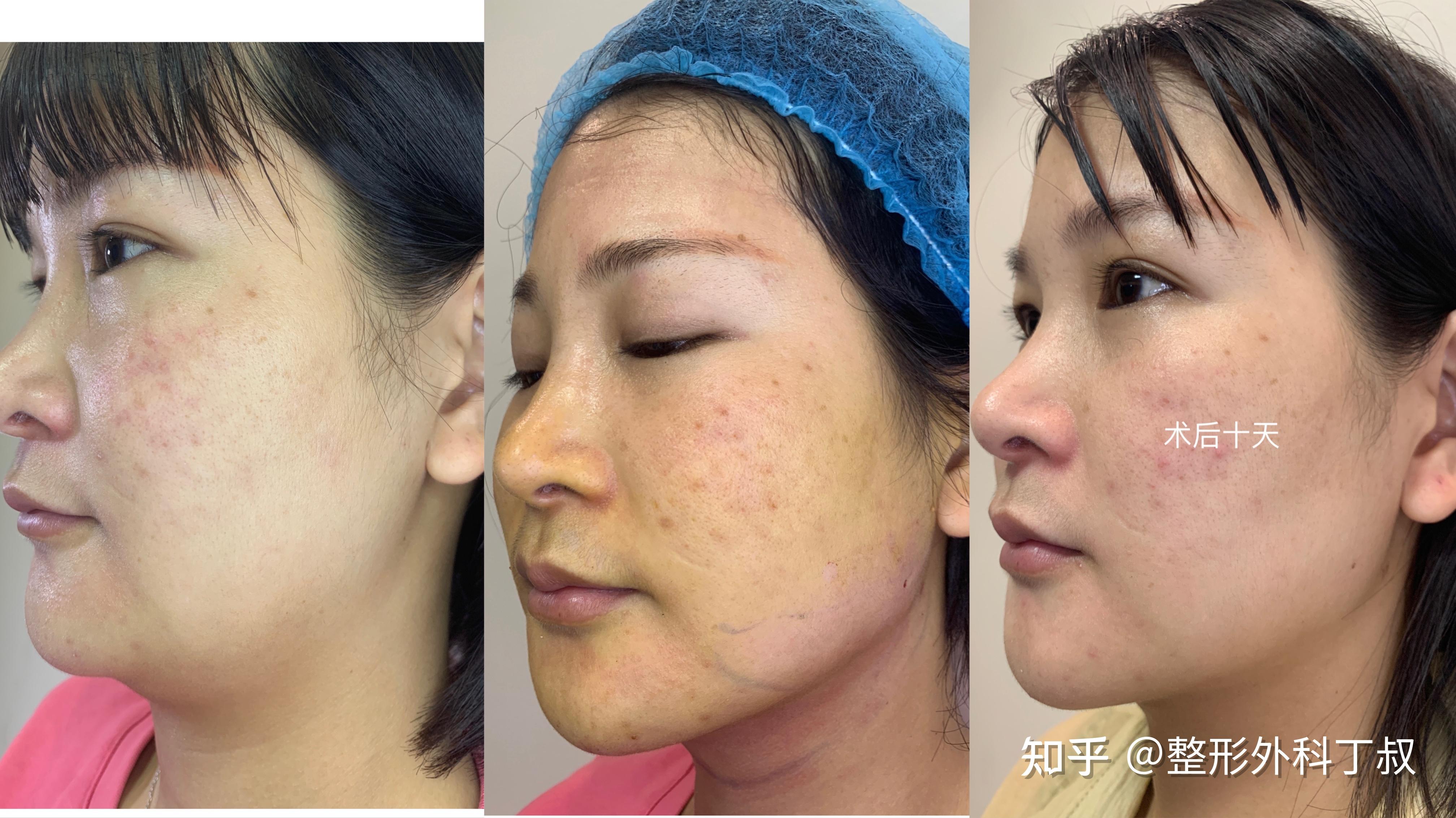 快速瘦身（Slim fast） 快速溶脂 3天见效 - Ayaskin Clinic ศัลยกรรมเสริมความงามใบหน้า ...