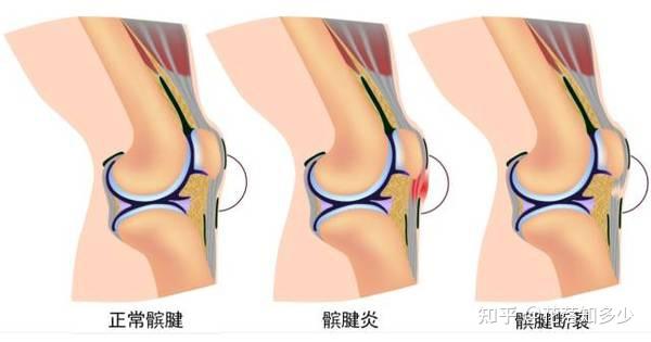 改善髕骨穩定性矯形器可用於髕骨脫位術前,術後固定,也可用於膝關節