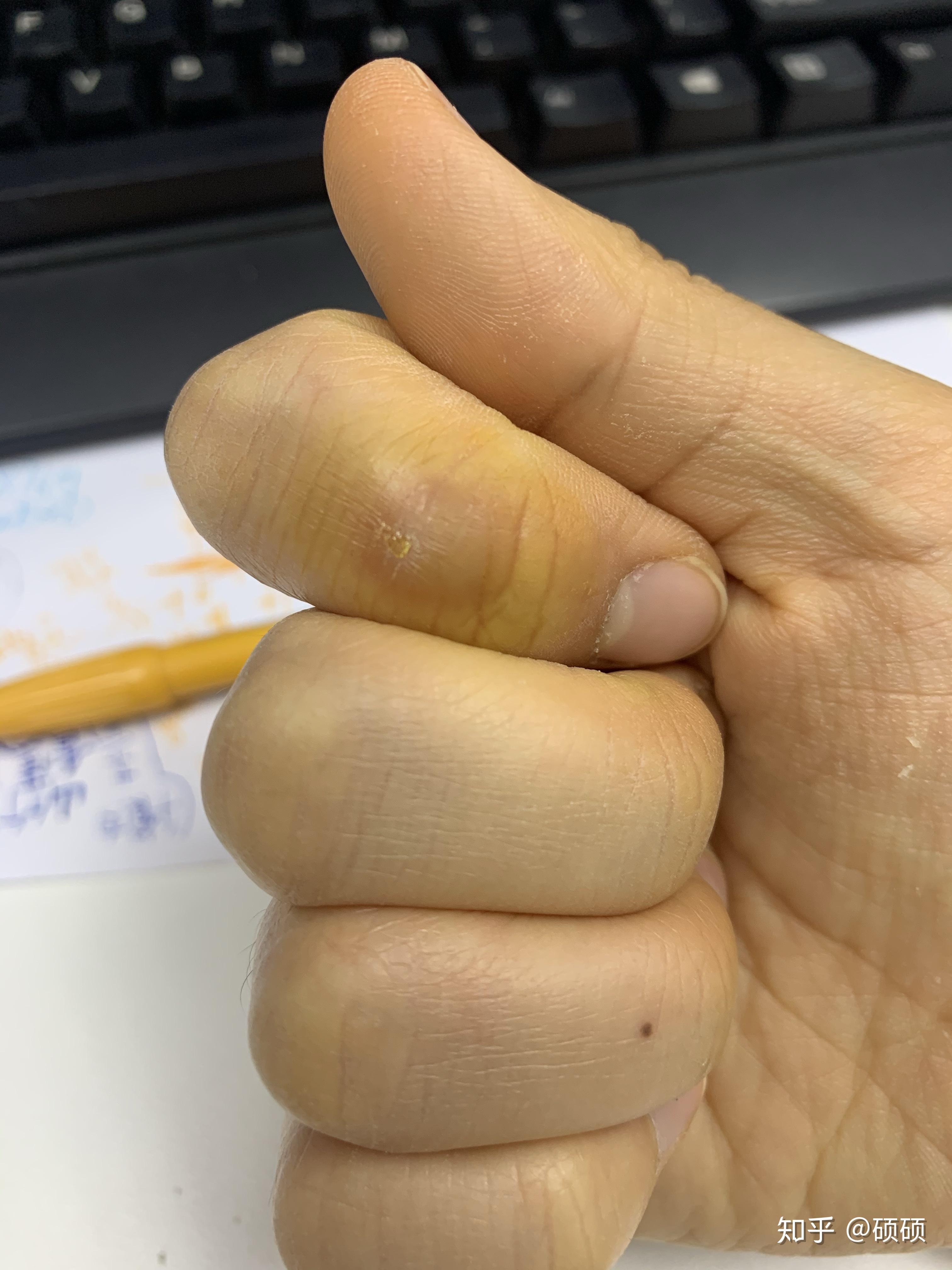 记录一下手上被烫了泡之后的自愈历程