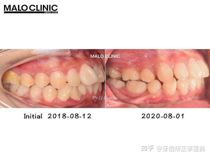 北京牙齿矫正丨骨壁薄患者易发生骨开窗做好规避风险的每一步