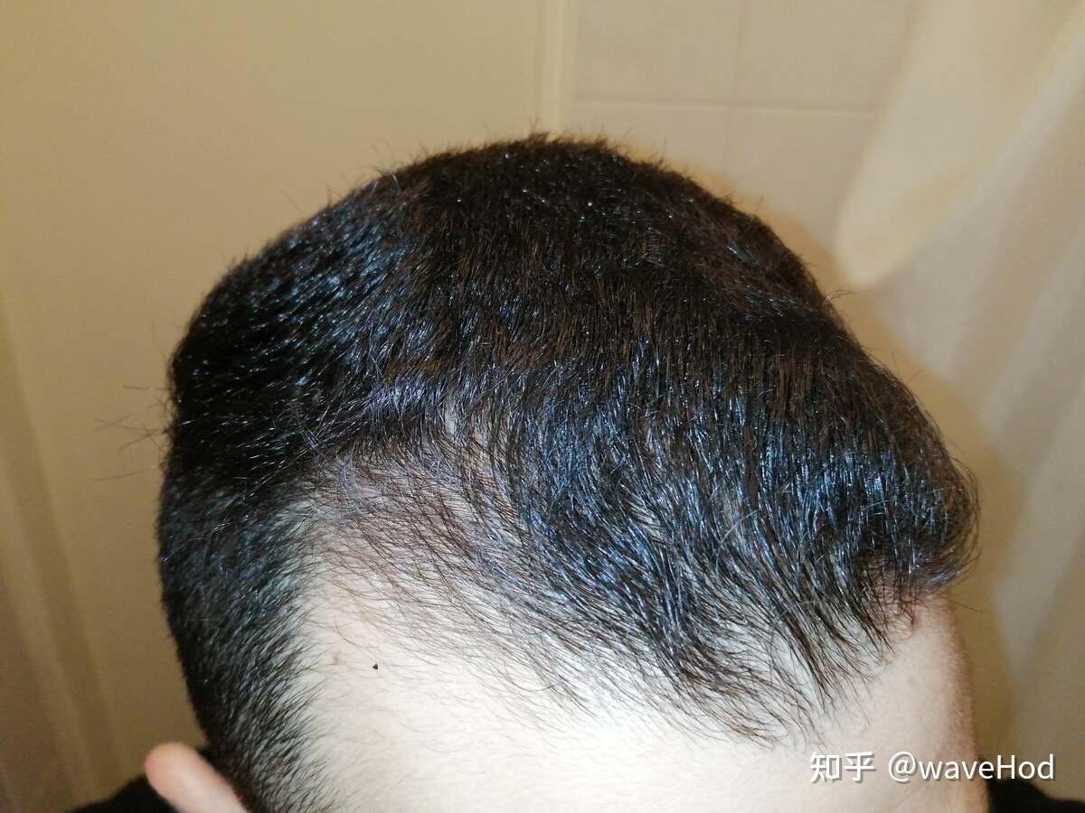 米诺地尔微针滚轮4个月的效果微针选择的详细说明