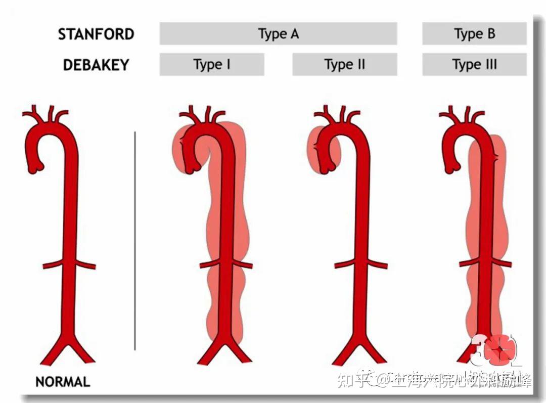 主动脉夹层stanford图片