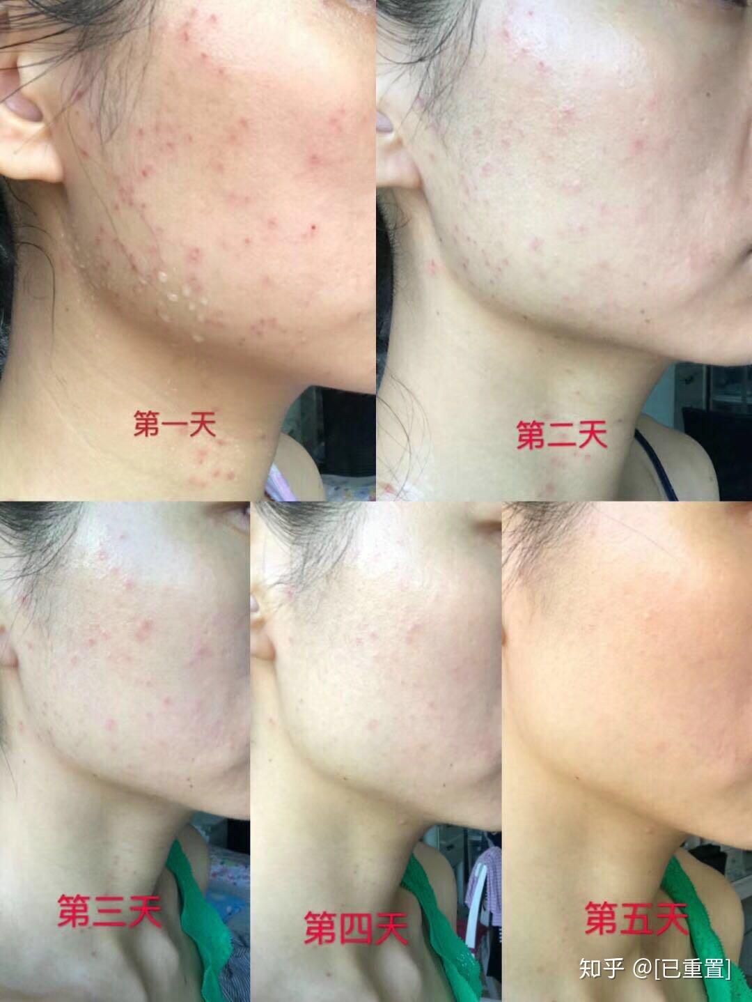 教你如何鉴别扁平疣和汗管瘤