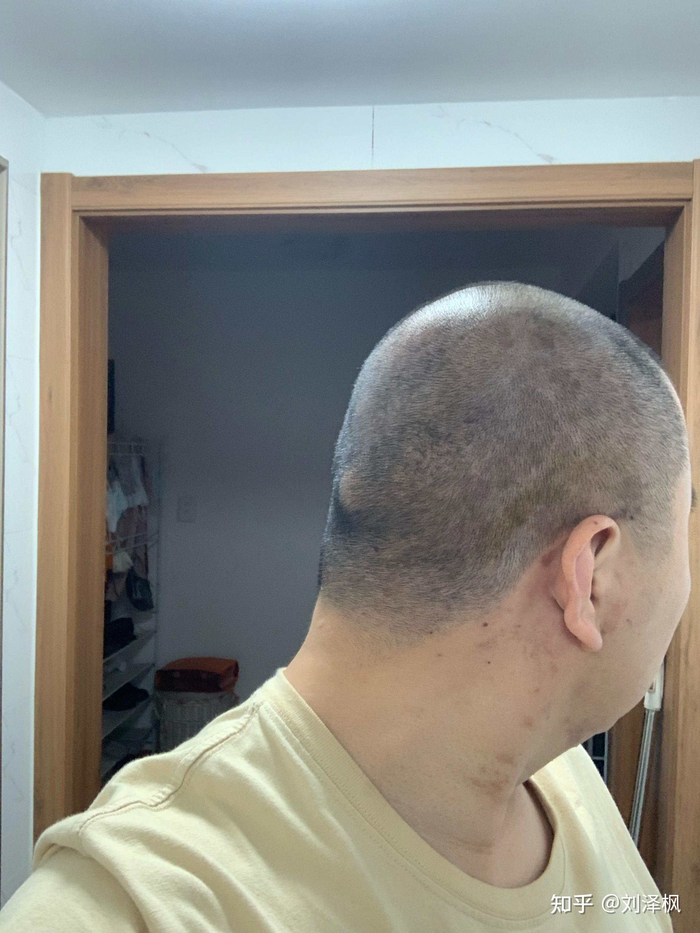 带状疱疹长脑袋上了