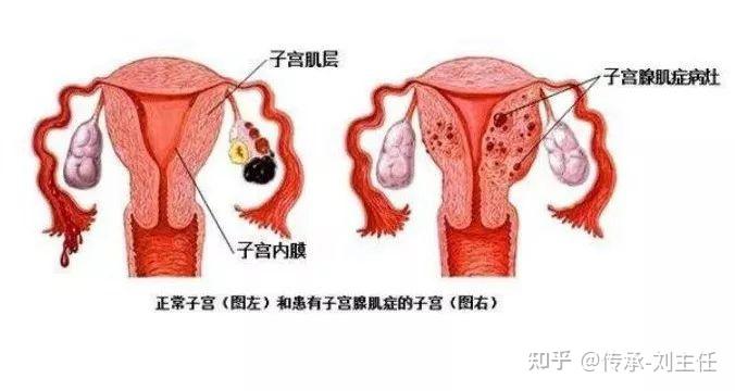 不死的癌症子宫腺肌症称霸子宫伤透女人