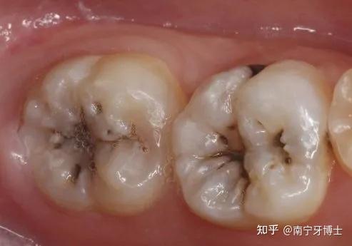 科普 | 牙齿上的谜之"黑线" 真的是我没刷干净?