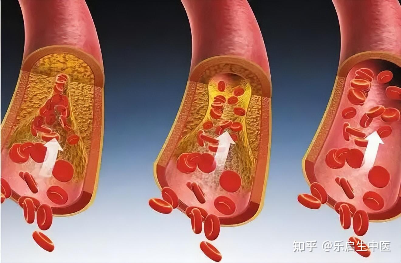 它還包括由於身體內水液代謝障礙而產生的,具有穢濁,黏滯,稠厚特徵的