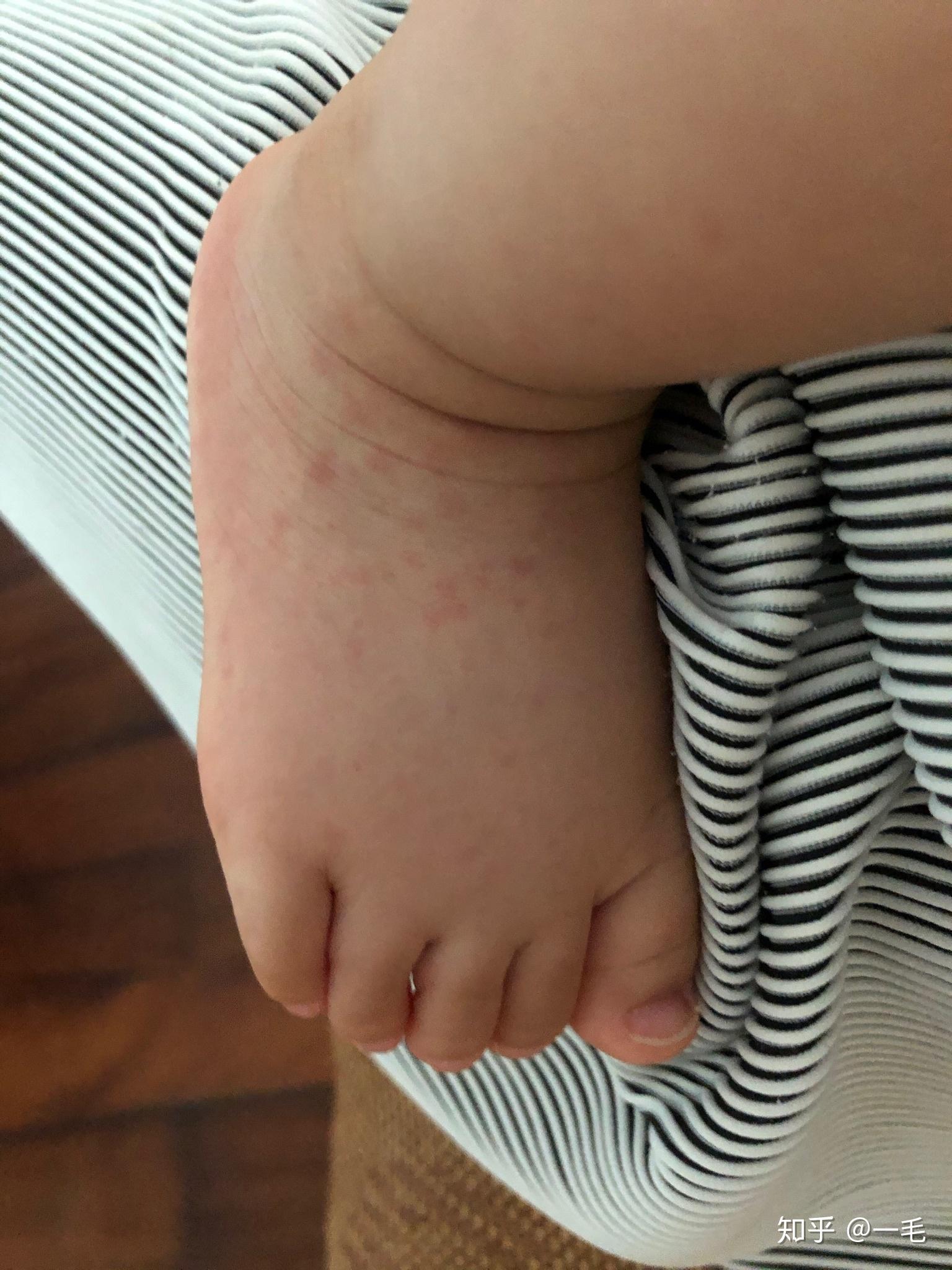 幼儿急疹子的症状图片图片