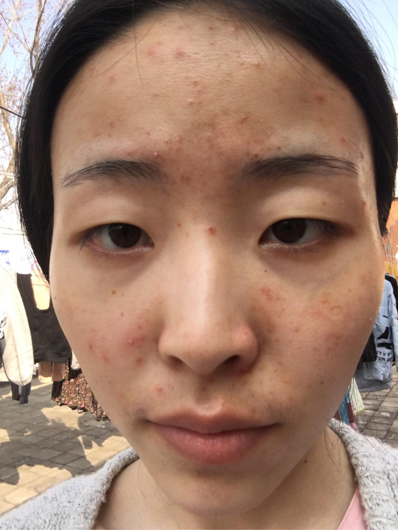 还算顺利的抗痘历程