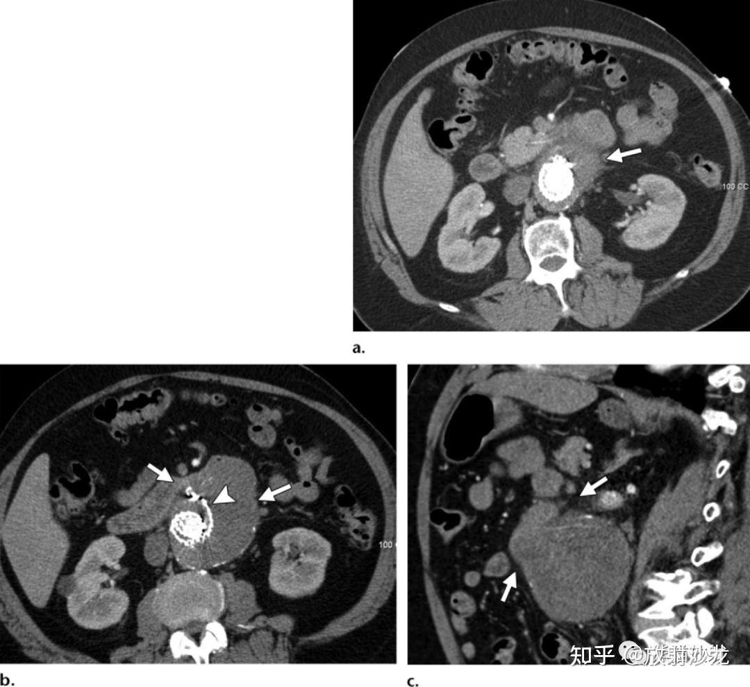 腹主动脉瘤的随访哪些ct征象提示其不稳定性