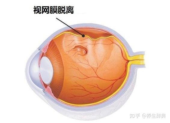 视网膜脱落前兆——飞蚊症2,视网膜脱落的另一个前兆就是视力障碍