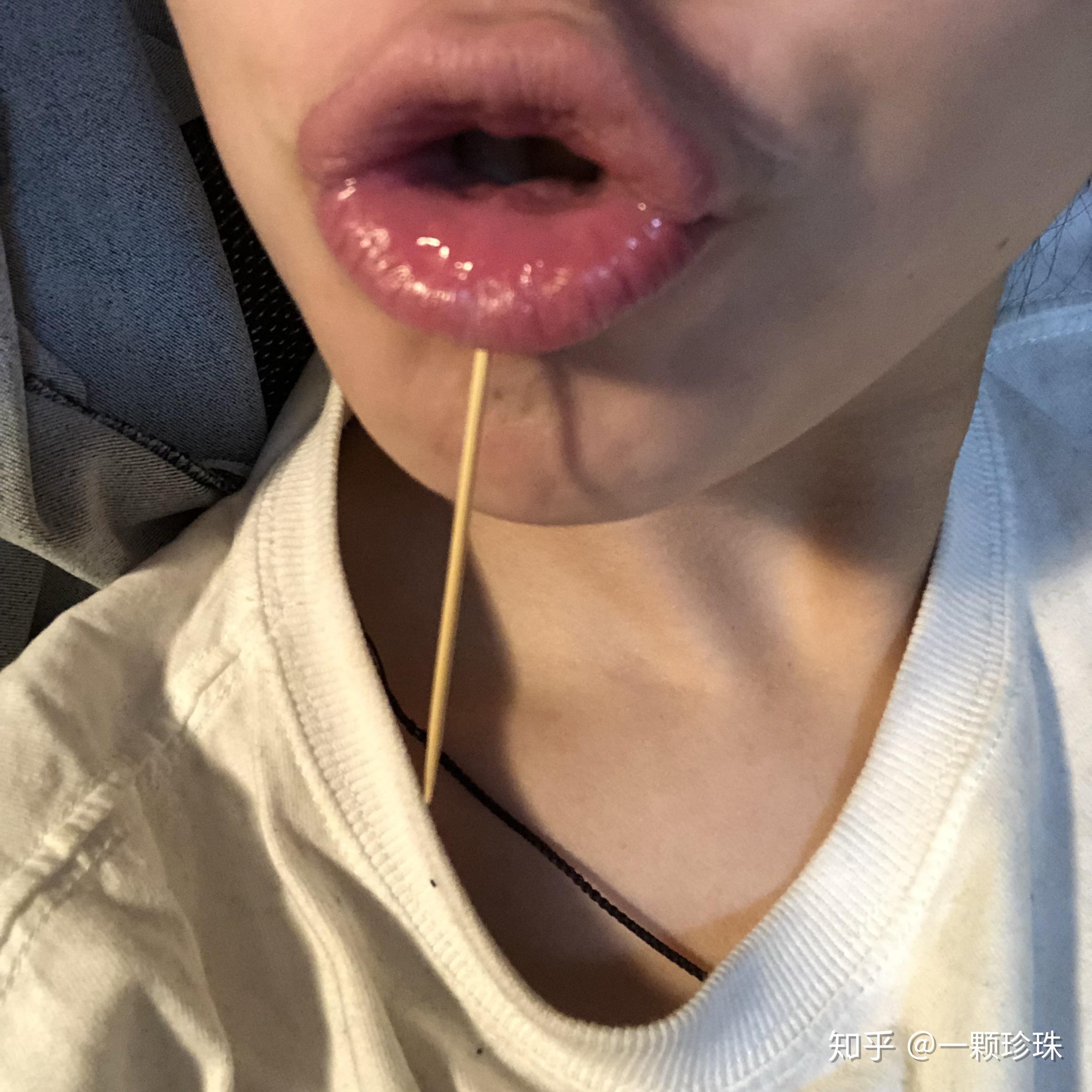 伟德国际打舌钉发炎有什么症状