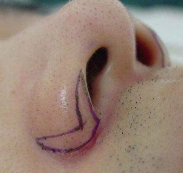 鼻部畸形图片图片