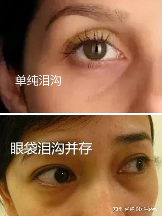 泪沟填充有6大常见方法1之玻尿酸填充篇